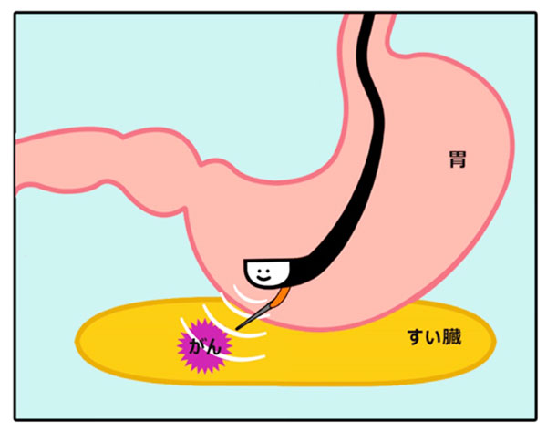 胃カメラ