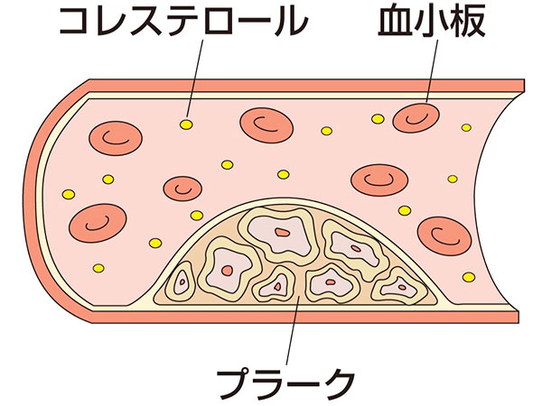 血管の石灰化